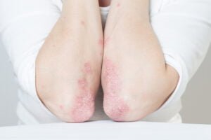 Lupus Hastalığı Neden Olur