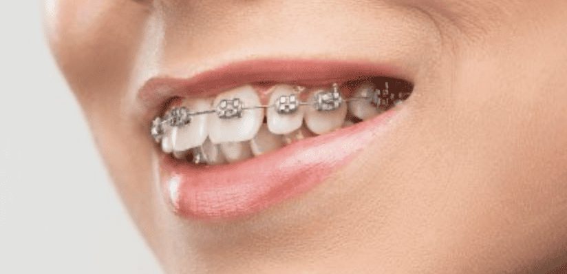 Ortodonti Tedavisi Sağlıklı Gülüşe Giden Yol